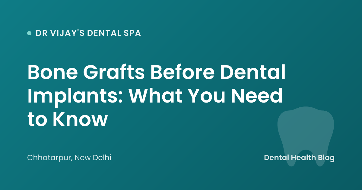 Bone Grafts Before Dental Implants: What You Need to Know